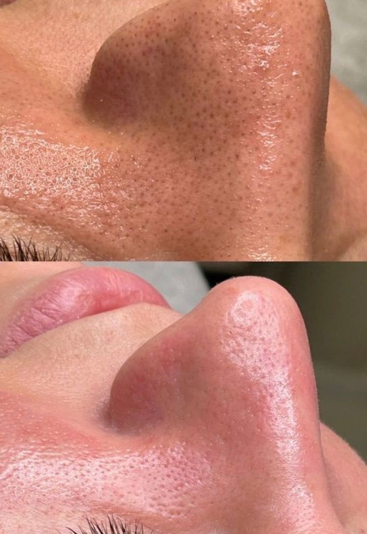 HydraFacial