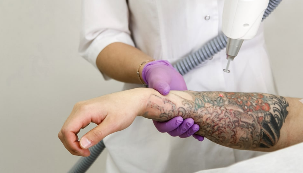 TATTOO REMOVAL
