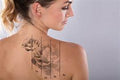 TATTOO REMOVAL