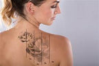 TATTOO REMOVAL
